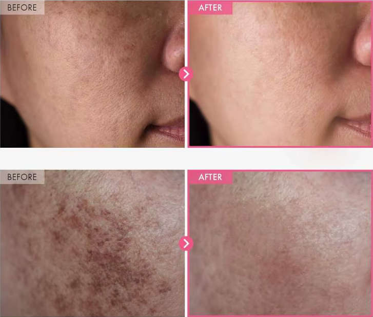 Dark Spot Remover Cream – Brightening & Acne Treatment for Clear Skin