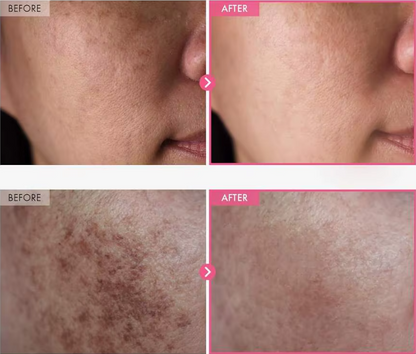 Dark Spot Remover Cream – Brightening & Acne Treatment for Clear Skin